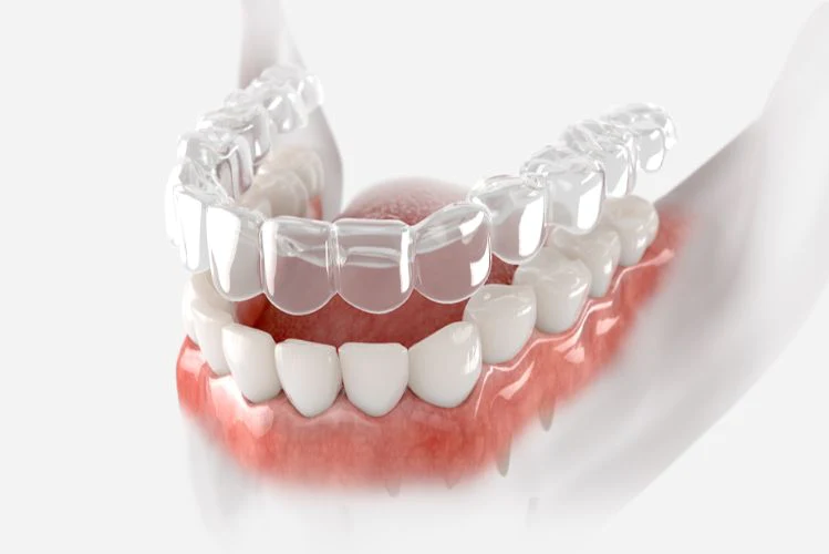 Dental retainer graphic